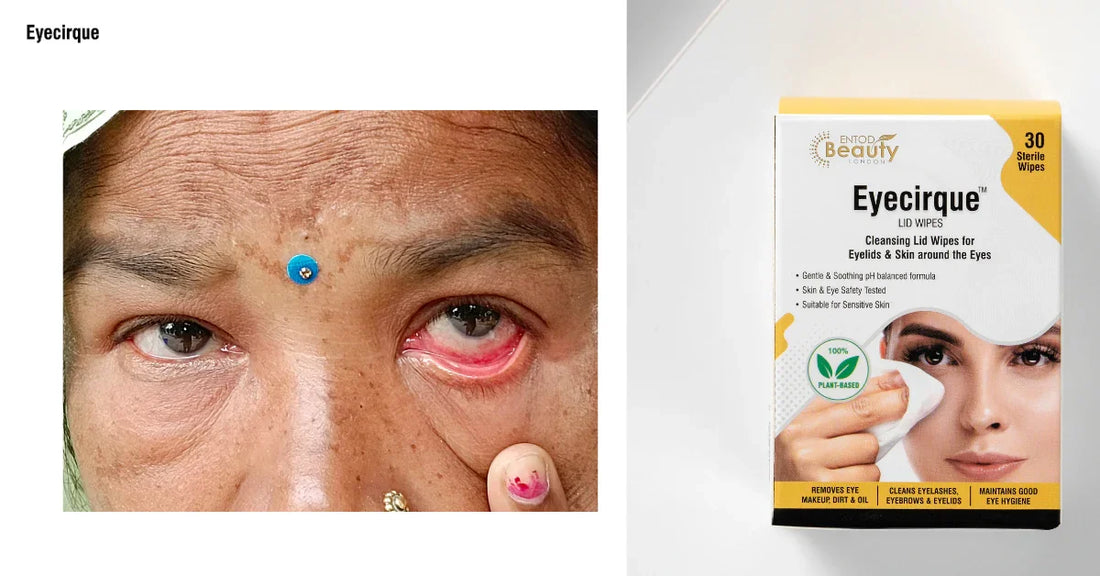 Benefits of Eyelid Wipes & Eyelid Hygiene