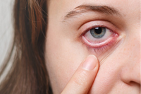 How to Know When You Need Eye Drops: 5 Signs of Dry Eyes