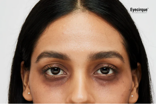 आँखों के नीचे काले घेरे: कारण, छुटकारा पाने के तरीके और Eyecirque की भूमिका (Dark Circles: Causes, Remedies, and the Role of Eyecirque)